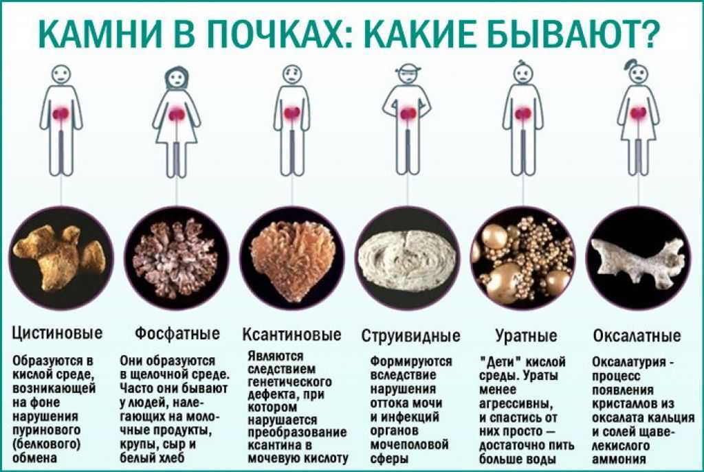 Мочекаменная болезнь (мкб)