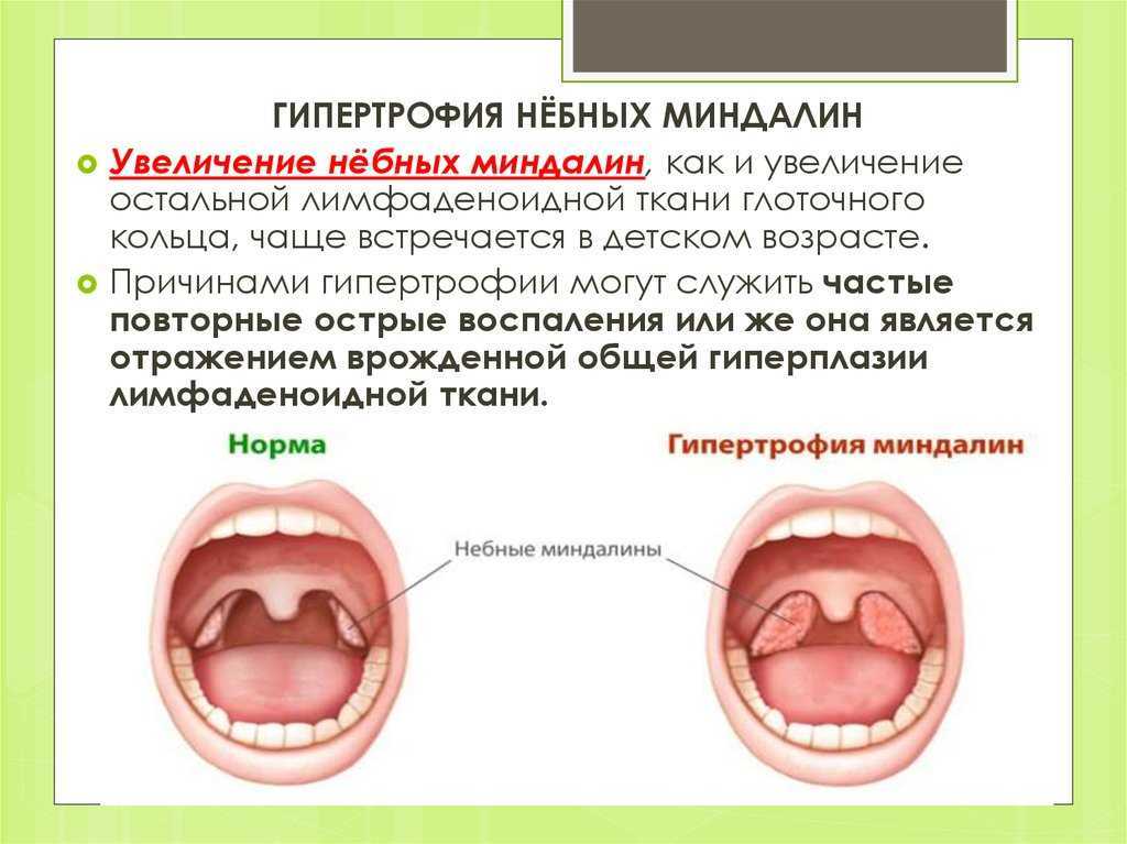 Гайморит: признаки, симптомы, лечение - медком