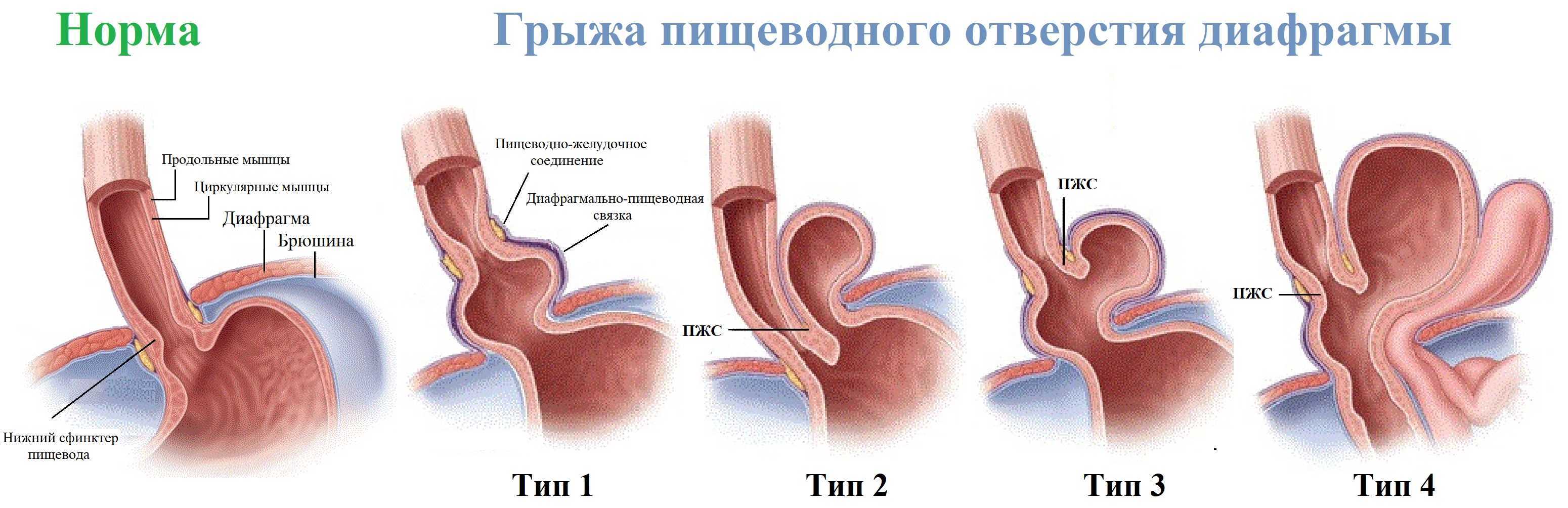 Заболевания пищевода. виды, диагностика и лечение.!