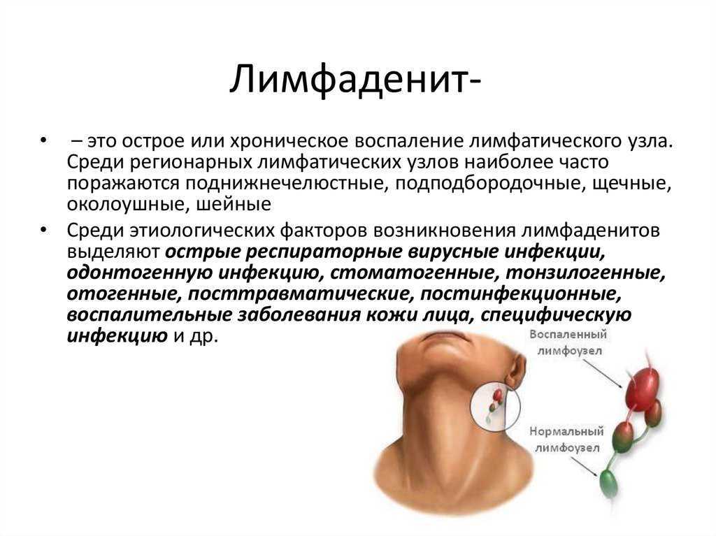 Мононуклеоз инфекционный