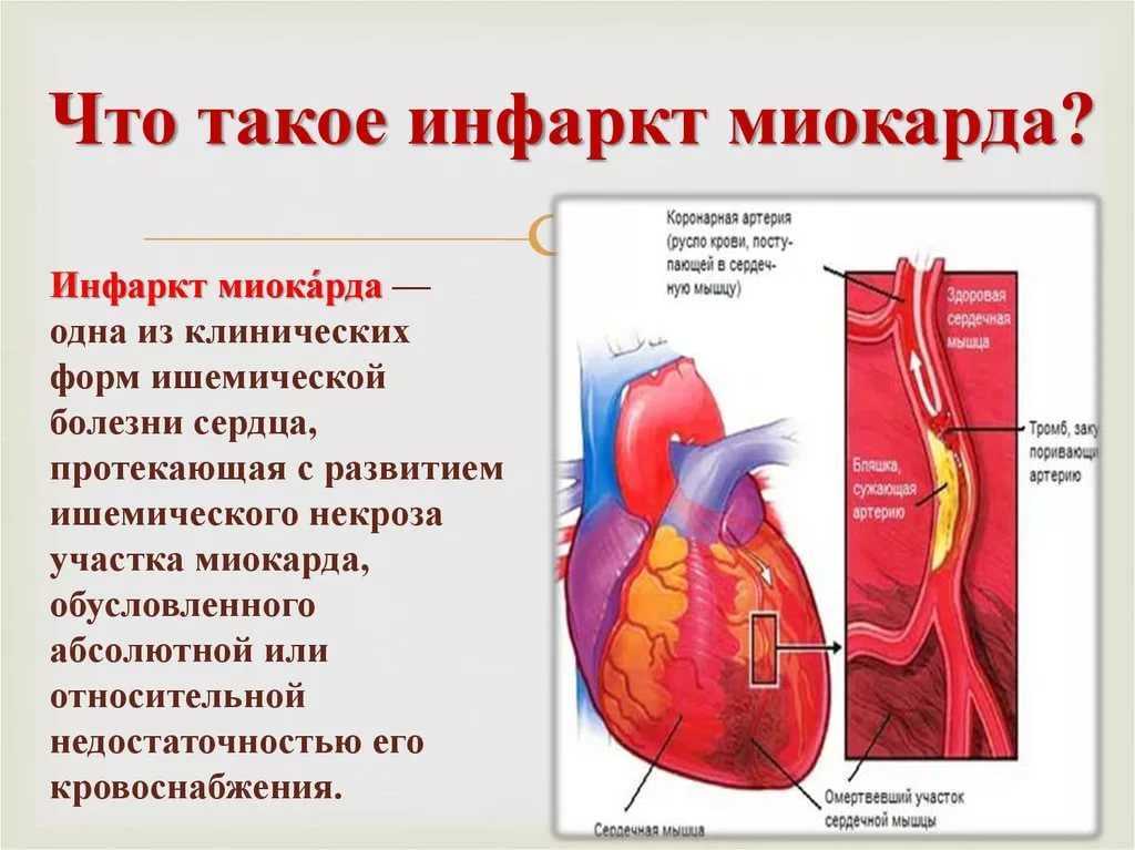 Признаки приближения инфаркта