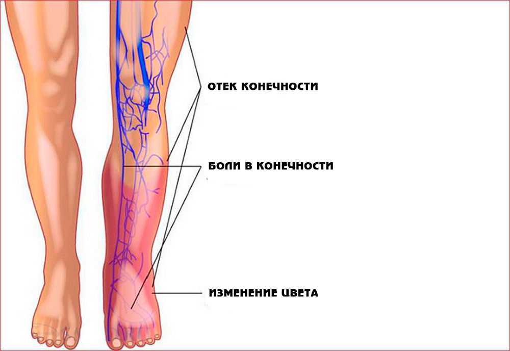 Тромбоз глубоких вен