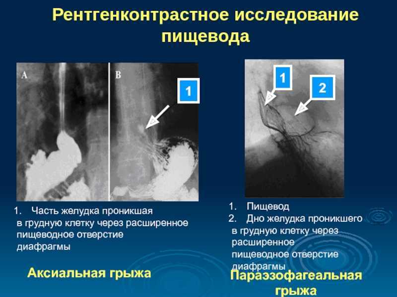Диафрагмальная грыжа - симптомы, методы диагностики и лечения
