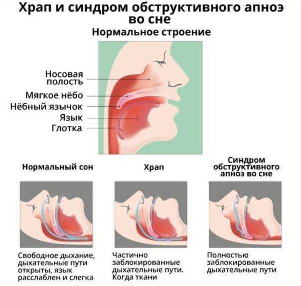 Медикаментозный ринит – опасные осложнения и лечение в цэлт