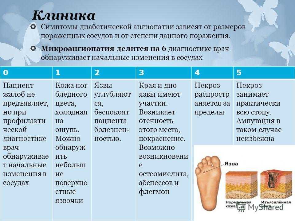 Ангиопатия сетчатки - виды, причины, симптомы, методы диагностики и лечения