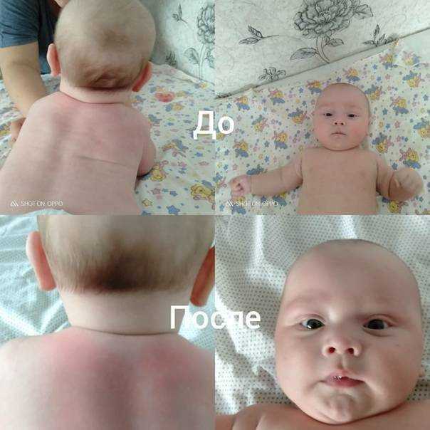 Искривление позвоночника (сколиоз, кифоз, лордоз). лечение