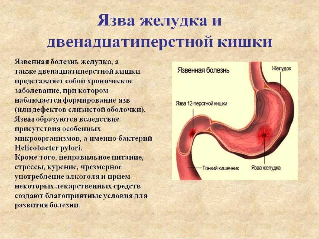 Болезнь крона: что это такое? симптомы, причины и лечение болезни крона у взрослых | клиники «евроонко»