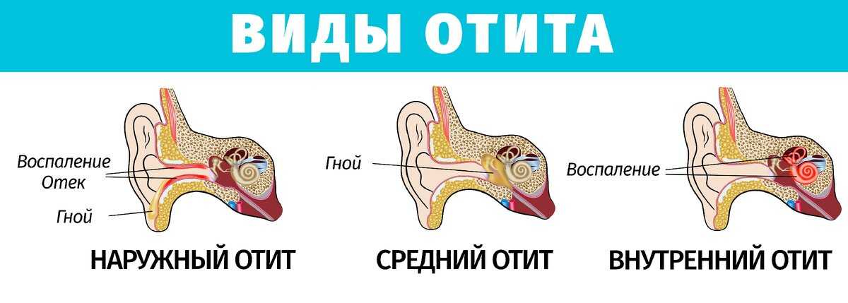 Отит уха у взрослого: симптомы и лечение, наружный, внутренний, средний. – эл клиника