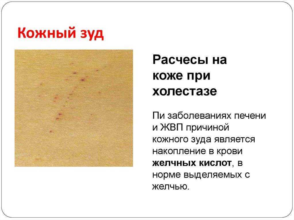 ? первые признаки цирроза печени ~?стадии и диагностика?