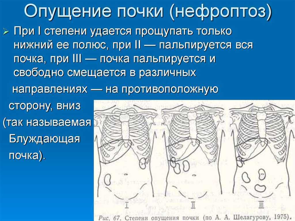 Нефроптоз (блуждающая почка, опущение почки)