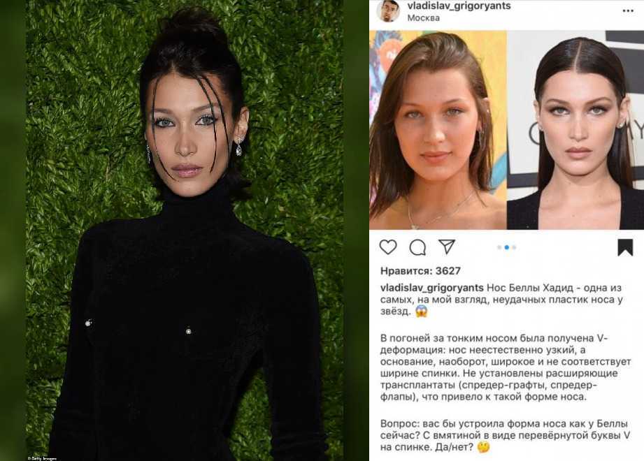 Эрчел ханде до и после пластики, фото, как выглядит сейчас 2021
