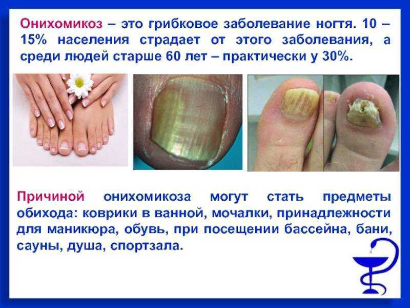 Мацерация кожи - это что такое в медицине описание причины проявления и методы лечения | подольская городская детская поликлиника № 3