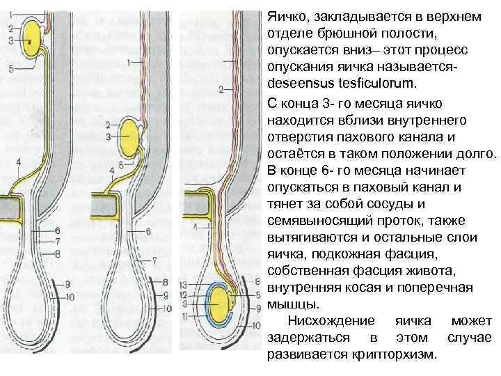Крипторхизм
