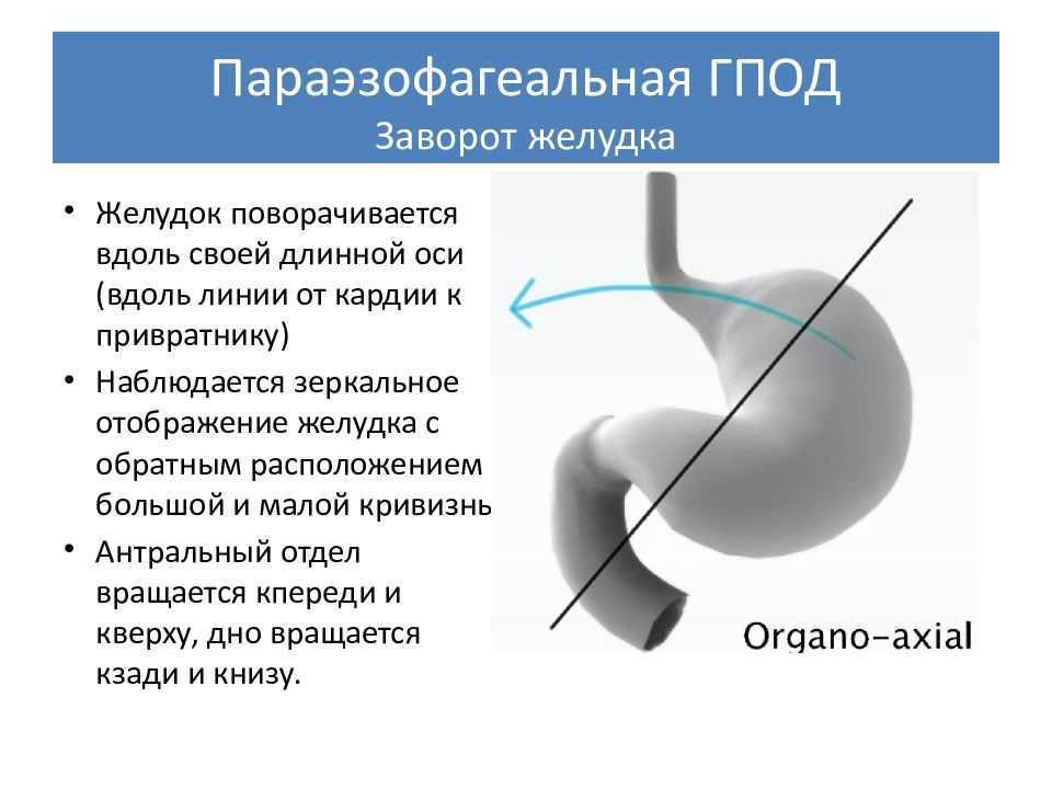 Грыжа пищевода: симптомы, лечение, диета, операция