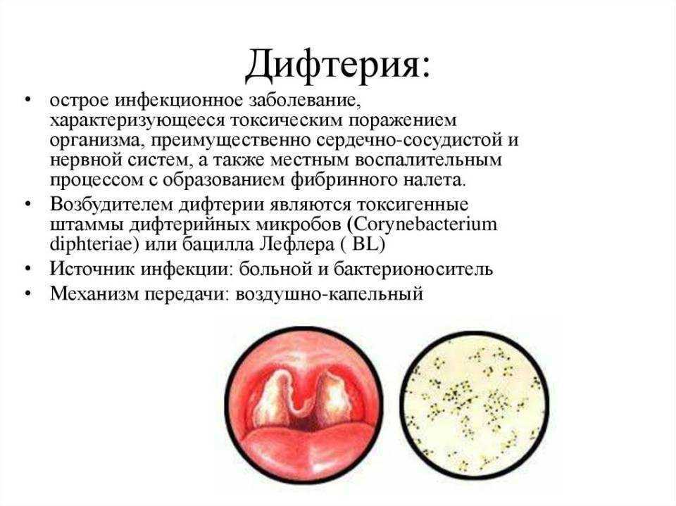Дифтерия. симптомы, диагностика, лечение и профилактика дифтерии