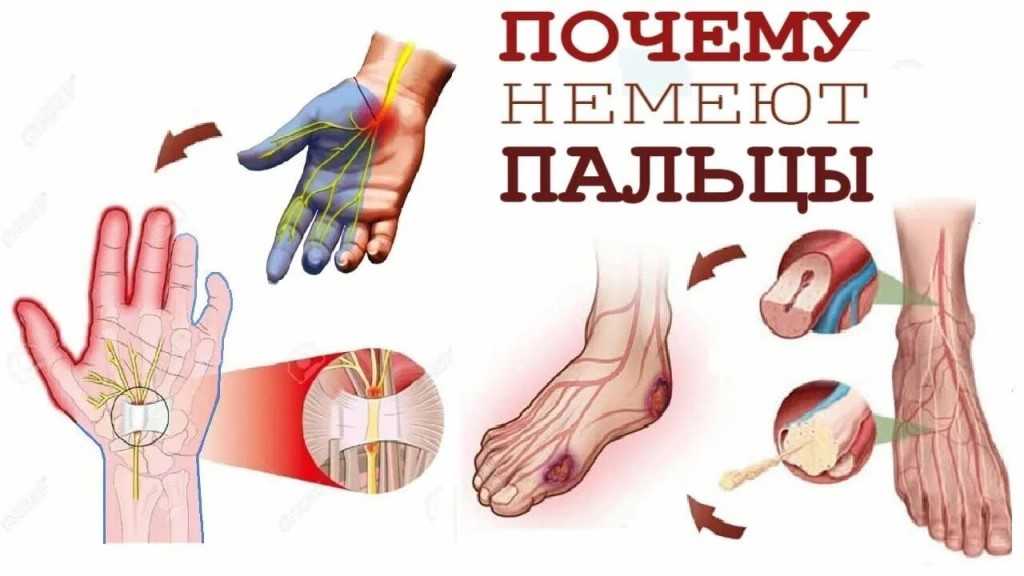 Немеют пальцы рук — что может быть вызвать этот симптом? - цэлт