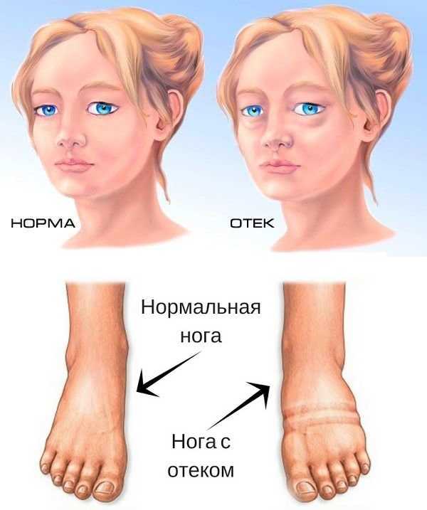 Заболевания почек: основные симптомы и признаки болезней почек