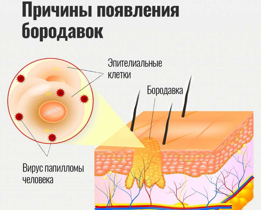 Чем опасен папилломавирус (впч). онкологические заболевания, связанные с hpv