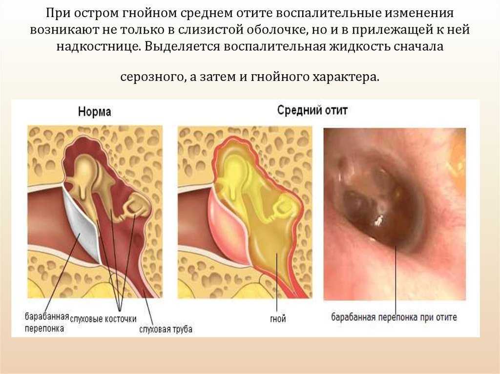 Мастоидит