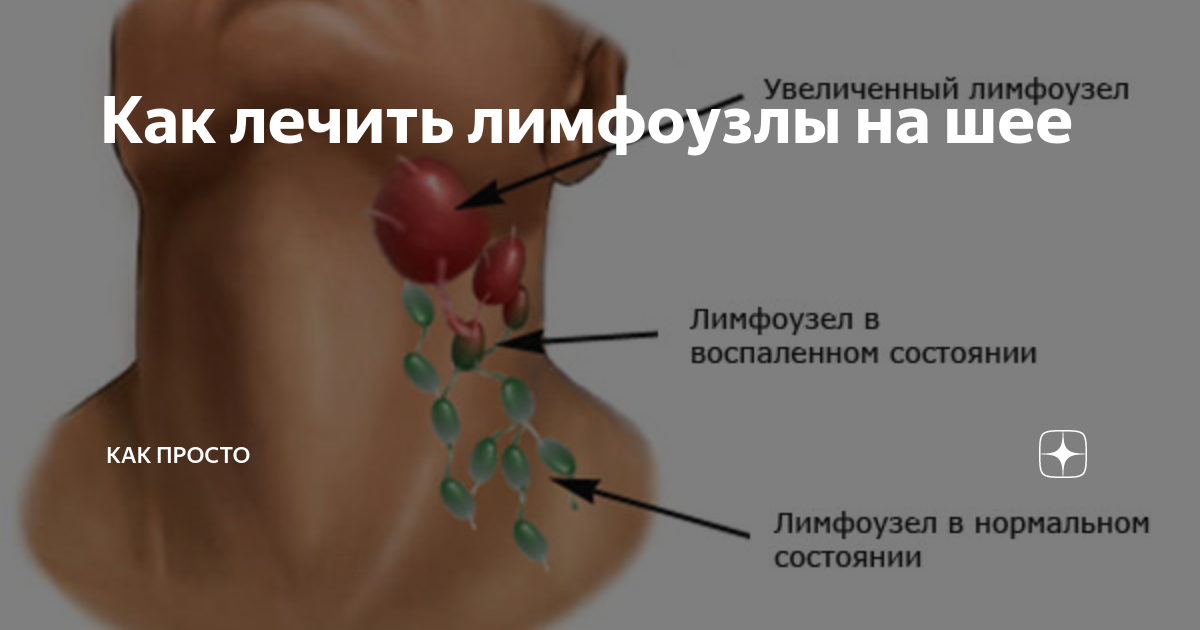 Атипичный мононуклеоз у детей: 16 симптомов, 6 осложнений, 10 методов лечения
