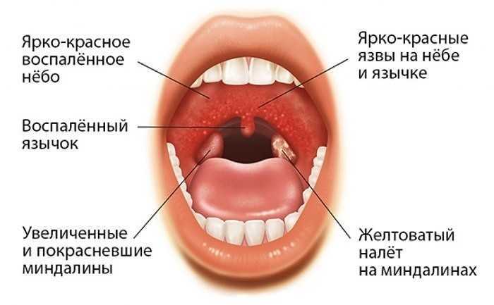 Стоматит и его виды. герпес как вид стоматита. причины и лечение.