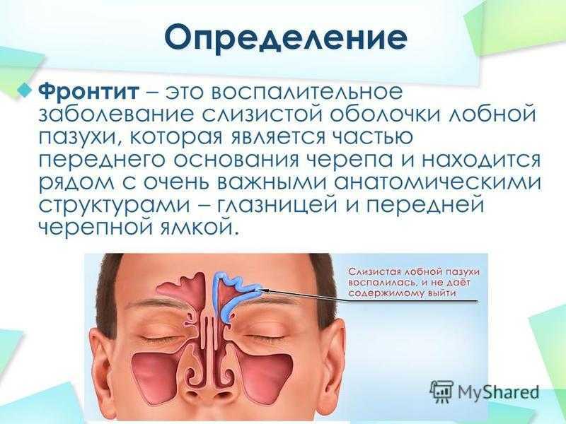 ? что такое фронтит? ~ ?симптомы и лечение?