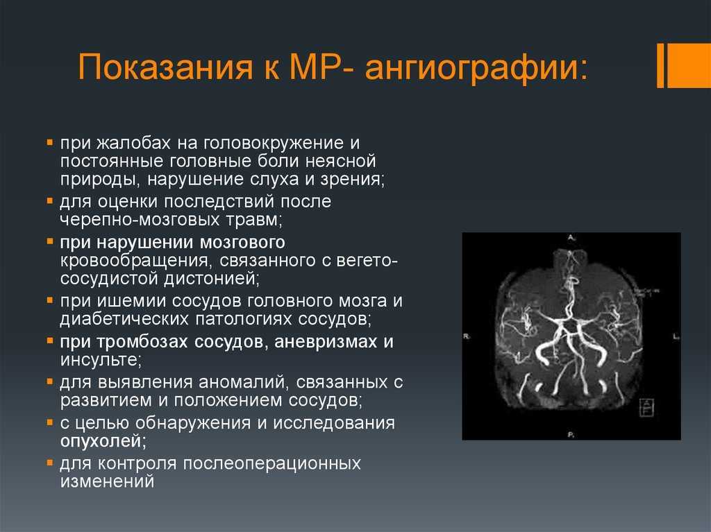 Мр-ангиография артерий головного мозга. показания и противопоказания к мр-ангиографии артерий головного мозга!