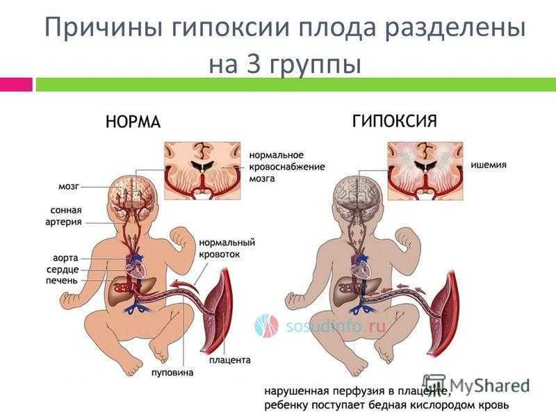 Асфиксия новорожденных - причины, оценка степеней по шкале апгар, этапы реанимации