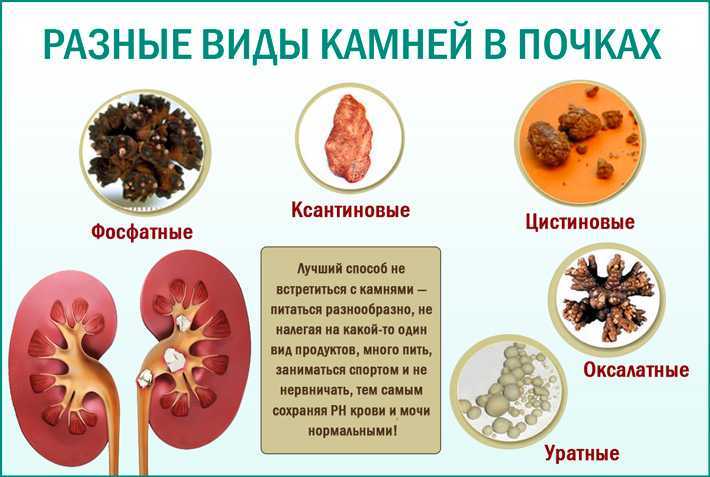 Инфекции мочевыводящих путей